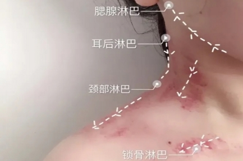 DERMA淋巴排毒